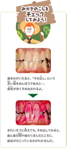 みがきのこしをチェックしてみよう!:歯をみがいたあと、「そめ出し」という赤い液をめんぼうでぬると…、歯垢が赤くそめ出されるよ。きれいそうに見えても、そめ出してみると、歯と歯の間や歯のくぼんだところに、歯垢がのこっているのがわかるんだ。