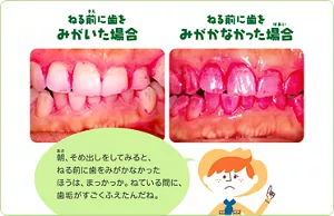 ねる前に歯を磨いた時と磨かなかった時。朝、そめ出しをしてみると、ねる前に歯をみがかなかったほうは、まっかっか。ねている間に、歯垢がすごくふえたんだね。