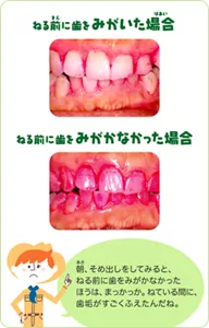 ねる前に歯を磨いた時と磨かなかった時。朝、そめ出しをしてみると、ねる前に歯をみがかなかったほうは、まっかっか。ねている間に、歯垢がすごくふえたんだね。