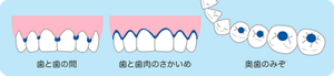 歯と歯の間/歯と歯肉のさかいめ/奥歯のみぞ