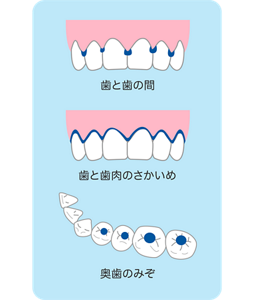 歯と歯の間/歯と歯肉のさかいめ/奥歯のみぞ