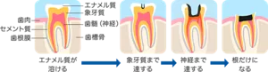むし歯の進行は、まずエナメル質が溶けて、象牙質まで達します。その後神経に達し、根だけになってしまいます。