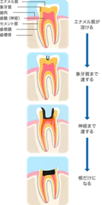 むし歯の進行は、まずエナメル質が溶けて、象牙質まで達します。その後神経に達し、根だけになってしまいます。