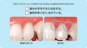 下記のいずれか、もしくは両方が当てはまる人は歯肉炎の恐れがあります。□歯みがきをすると出血する。□歯肉が赤くなり、はれている。