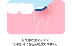 奥歯の永久歯が生えるまでは、歯と歯ぐきのさかいめにハブラシが当たりにくいため、歯垢がたまりやすくなります。