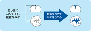 むし歯になりやすい複雑なみぞに、樹脂をつめてみぞをうめることを言います。