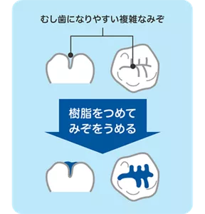 むし歯になりやすい複雑なみぞに、樹脂をつめてみぞをうめることを言います。