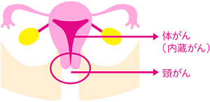 子宮がんが発生する場所のイメージ。 頸がんは子宮の入口に、体がんは子宮の内部に発生する。