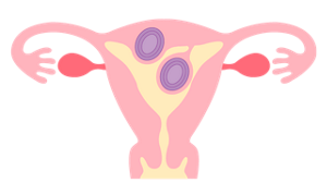 粘膜下筋腫のイメージ。