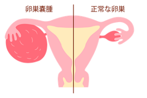 卵巣嚢腫と正常な卵巣の比較イメージ。卵巣嚢腫は卵巣が大きく腫れあがっている。