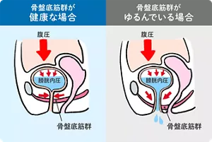 骨盤底筋が健康な場合と、ゆるんでいる場合の比較イメージ。 骨盤底筋群が健康な場合は、腹圧がかかり膀胱内圧がかかっても、骨盤底筋群が収縮し尿もれが起こらない。ゆるんでいる場合は、腹圧がかかり膀胱内圧がかかると、骨盤底筋群の収縮が弱く、尿もれが起こる。