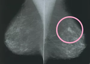 マンモグラフィで撮影した乳房のイメージ。