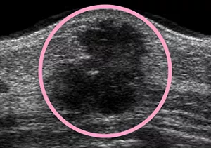 超音波診断装置(エコー)で撮影した乳房のイメージ。