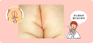 先生のコメント:少し赤みが気になります。