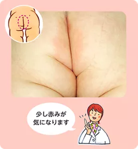 先生のコメント:少し赤みが気になります。