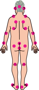 褥瘡のできやすところに印を付けたイラストイメージ