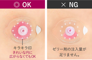 ゼリー剤の注入量目安の比較。左側はシールのキラキラ印まで満たした正しい注入量。右側はゼリー剤の注入量が足りずキラキラ印まで届いていないNGの状態。