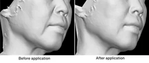 Comparison of 3D images taken before and after a model preparation was applied. While the nasolabial lines are visible before application, they are less visible after it.