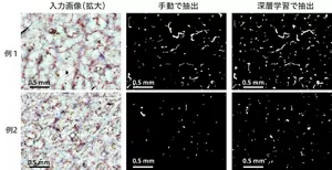 図3 開発したデバイスで撮影した毛細血管の拡大画像から、手動で毛細血管を白く塗った画像と深層学習で自動抽出した画像を比較。