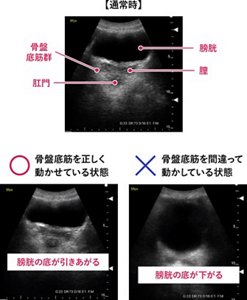 【通常時】○骨盤底筋を正しく 動かせている状態 膀胱の底が引きあがる ×骨盤底筋を間違って 動かしている状態 膀胱の底が下がる