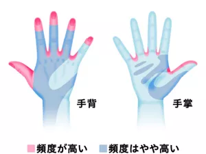 手洗いミスの発生部位を示すイラスト。出典 : 辻 明良(日本環境感染学会監修)病院感染防止マニュアル(2001)。引用 : 厚生労働省「高齢者介護施設における感染対策マニュアル(H25版)」。出典より一部改変。 手背と手掌で、手洗いミス発生頻度が高い部分は赤色、頻度がやや高い部位は青色で示す。手背における赤色部分は、親指全体と、その他の指の指先と、指の付け根。青色部分は、手首から手の甲、指の第1関節にかけて全体的に。手掌における赤色部分は、親指の腹部分全体と、指の付け根。青色部分は、親指の外側から付け根部分と、手のひらの半ば全体。