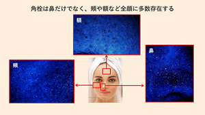角栓の蛍光特性を活用して可視化すると、角栓は鼻だけではなく、頬や額など顔全体に多数存在することが分かる。