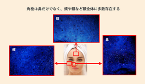 角栓の蛍光特性を活用して可視化すると、角栓は鼻だけではなく、頬や額など顔全体に多数存在することが分かる。