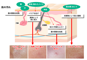 汚れが肌に与えるさまざまな悪影響のうち、特に角栓は毛穴をふさいで菌の繁殖を助長するため、ニキビなどに繋がると考えられている。