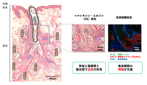 毛穴の奥深くから存在する角栓。毛穴の中の数多くの皮脂腺から角栓のもとになる皮脂が分泌されている。皮脂腺と角栓の接合部での炎症のほか、表皮細胞の増殖と角層細胞の接着不全も示唆された。