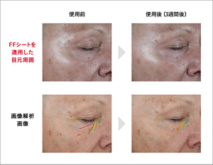 ファインファイバーを使用することで目元の形状が改善した素肌画像と解析画像(連用前と3週間後)