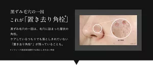 黒ずみ毛穴の一因これが「置き去り角栓」黒ずみ毛穴の一因は、毛穴に詰まった層状の角栓。ケアしているつもりでも落としきれていない「置き去り角栓*」が残っていることも。*ソフィーナ美容液洗顔料では落としきれない角栓