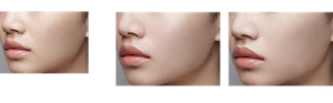 Before After FOR DRY SKIN Finished image FOR OILY SKIN Finished image