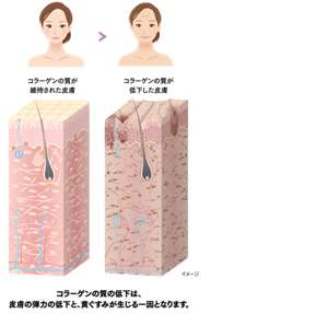 イメージ図：すこやかな皮膚とコラーゲンの質が低下した皮膚　コラーゲンの質の低下は、皮膚の弾力の低下と、黄ぐすみが生じる一因となります。
