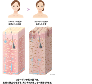 イメージ図：すこやかな皮膚とコラーゲンの質が低下した皮膚　コラーゲンの質の低下は、皮膚の弾力の低下と、黄ぐすみが生じる一因となります。