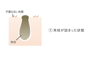Wポアアプローチ処方　角栓が詰まった状態のイメージ