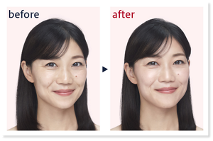 before after