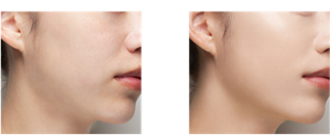 Before After