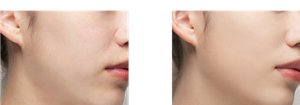 Before After