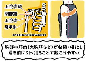 胸部の筋肉（大胸筋など）が収縮・硬化し肩を前に引っ張ることで起こりやすい