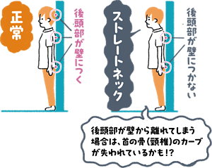 ストレートネック　チェック法　イラスト