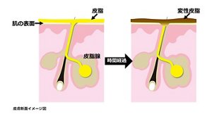 皮脂が時間経過とともに変性皮脂に変化することを示した皮膚断面イメージ図