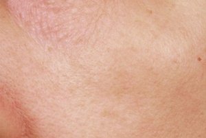 写真：シミが少なく、ハリのある肌の事例