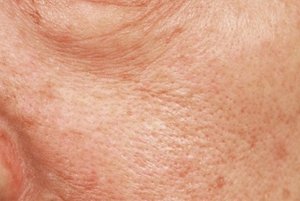 写真：シミがあり、ハリの低下が見られた肌の事例