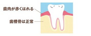 図：歯肉炎のイメージ　歯槽骨は正常、歯肉が赤くはれる