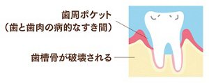 図：歯周炎のイメージ　歯と歯肉の病的なすき間（歯周ポケット）ができる、歯槽骨が破壊される