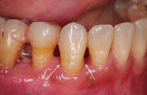 基本治療後歯周組織再生を図った写真