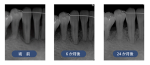 術前、6ヶ月後、24ヶ月後のX線写真