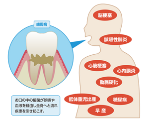 お口の中の細菌が誤嚥や血液を経由し全身へと流れ疾患を引き起こす。関連する全身疾患：脳梗塞、誤嚥性肺炎、心筋梗塞、心内膜炎、動脈硬化、低体重児出産、糖尿病、早産。