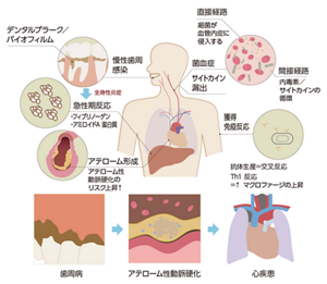 歯周組織の断面のイラスト。歯周ポケットにバイオフィルムに守られた縁下プラークがあり、破骨細胞によって歯槽骨の破壊が起こっている。
