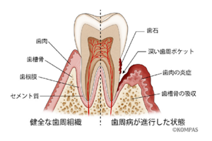 健全な歯周組織と歯周病が進行した状態のイラスト。